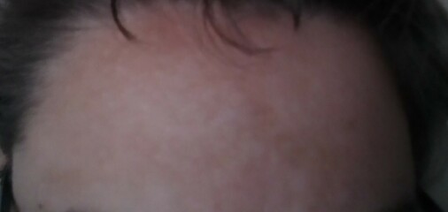 Lip shadow/melasma?