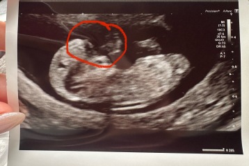 Is my 11 weeks and 3 days scan normal?