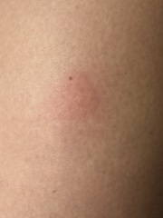 Insect bite (with photos)