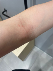 Teen daughter full body rash