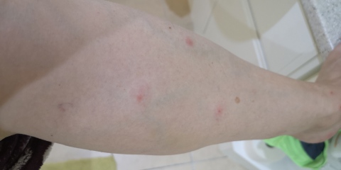 AIBU to ask if these are bed bug bites?