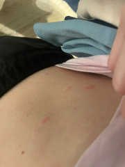 Teen daughter full body rash