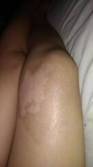 Will this 2nd degree burn leave a scar?