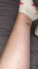 Rash and itch