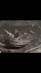 Boy or girl - any guesses from scan?