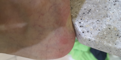 AIBU to ask if these are bed bug bites?
