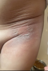 What is happening to my son's skin?