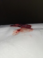 Miscarriage or blood clot
