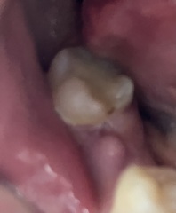 Dentists please help- is this an abscess?