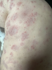 Random rash and bruises