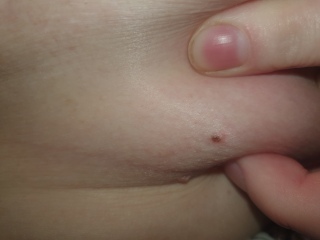 New mole