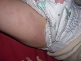 Does anyone know what this rash is and how to treat?