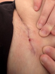 Anyone know what this could be on my c section incision?