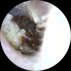 Ear wax / infection