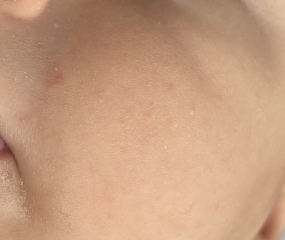 Is this baby acne at 4 months old?