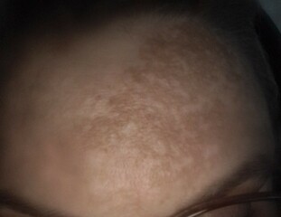 Lip shadow/melasma?