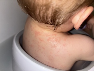 1 year old potentially has chicken pox. Wife pregnant with baby #2