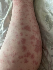 Random rash and bruises