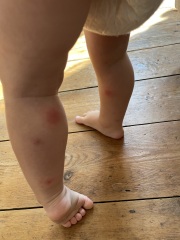 Advice please on mosquito bite
