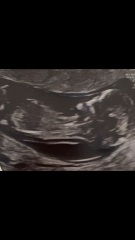 Boy or girl - any guesses from scan?