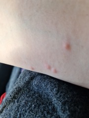 Help! Bedbugs! How did you get rid of yours?