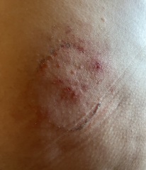 Rash from HRT patch, or shingles?
