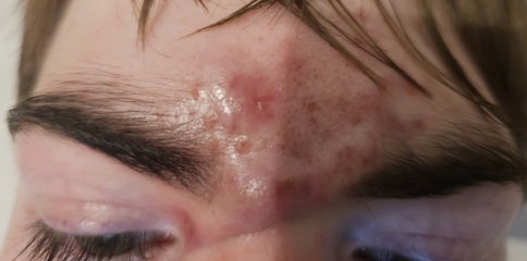 My son has cysts on his face - seeking advice
