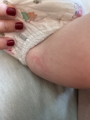 Daughters itchy palms for 2 weeks