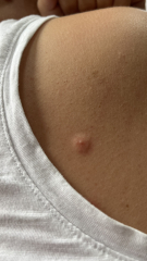 Is this chicken pox? << TW pics included >>