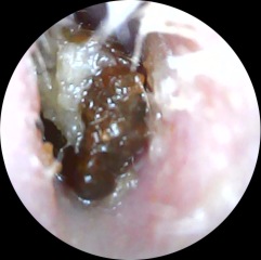 Ear wax / infection