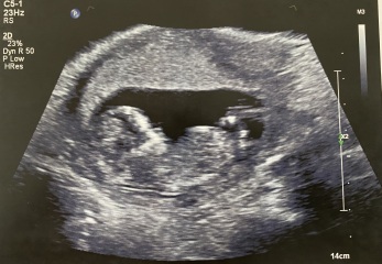 Girl or Boy predictions (13 weeks)