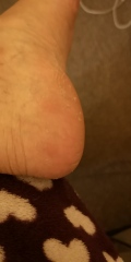 AIBU to ask if these are bed bug bites?