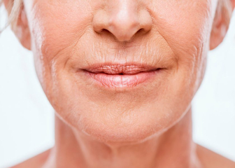 Lines above top lip - what can I do?