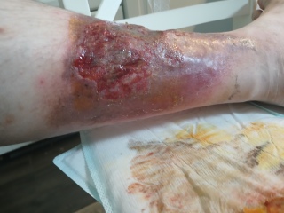 Husband leg infection being almost ignored (disgusting pics included)