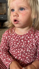 Advice on rash