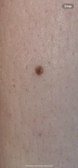Mole/freckle with white spot in it. Can anyone reassure me please