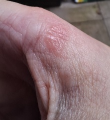Hand infected (Warning, gross photos)