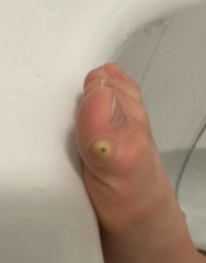 Panicking about how quickly this wart has changed