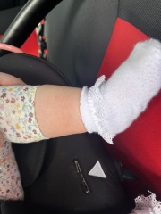 Weird spots that calm down and flair up