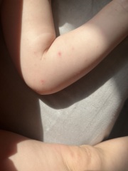 Hand Foot and mouth or chicken pox??