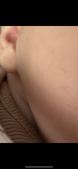 Red spots appearing on baby face?
