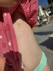 Toddler random spots