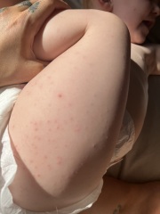 Hand Foot and mouth or chicken pox??