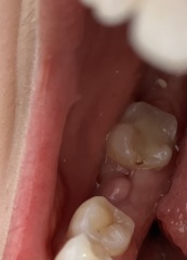 Dentists please help- is this an abscess?