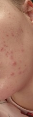 Acne at 30