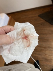 Implantation bleeding *graphic picture*