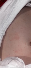 Rash - 1 year old?