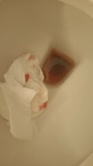 Anyone had Polyps in pregnancy?