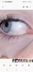 Bloodshot eye for days