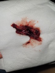 Miscarriage or blood clot